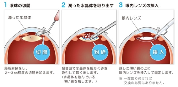 白内障手術について